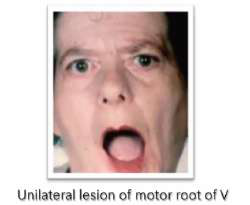 Motor root lesion