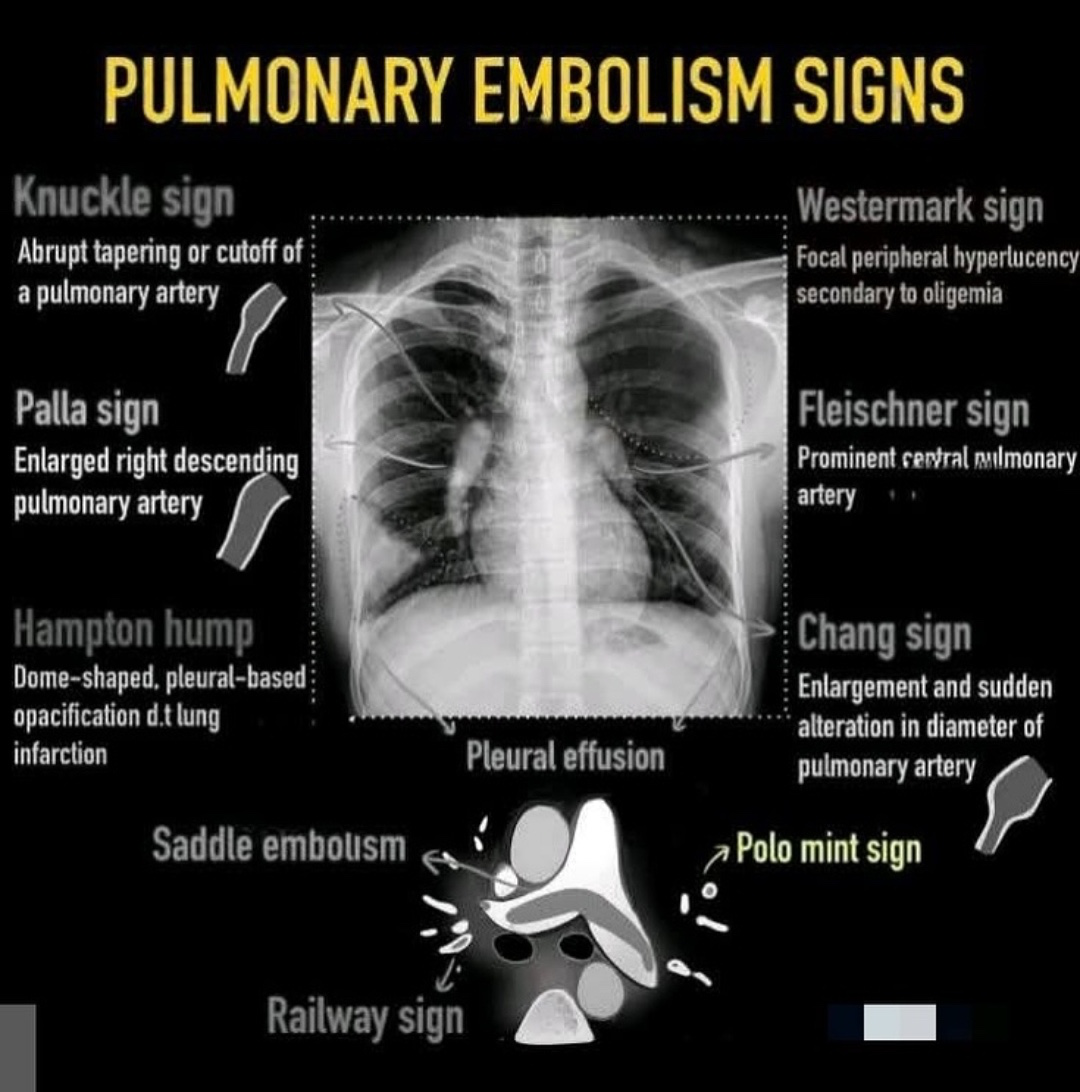 Pulmonary embolism chest X-ray signs