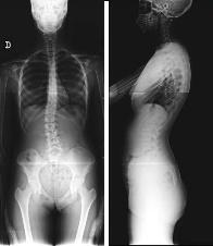 X-rays de columna con escoliosis