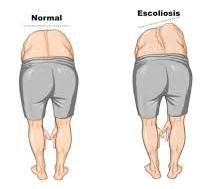 Diagrama normal vs escoliosis