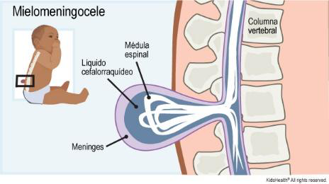 Diagrama de mielomeningocele