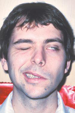 man with left-sided facial paralysis