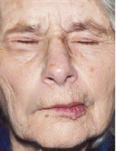 elderly woman with right-sided facial paralysis