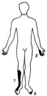 A diagram of the human body indicating three potential areas of mononeuropathy.