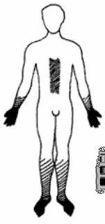 Diagram of sensory loss distribution
