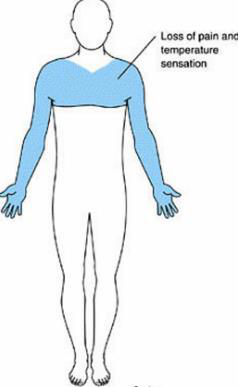 Loss of pain and temperature sensation