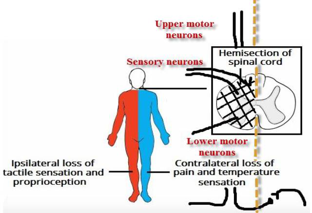 Diagram showing hemisection of the spinal cord