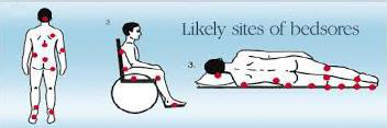 Likely sites of bedsores
