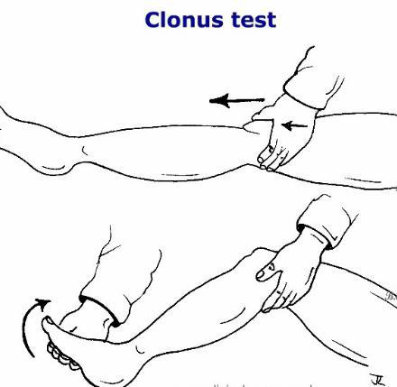 clonus test illustration