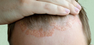 A sectional view of skin is shown with labels for epidermis, dermis, papillary dermis, reticular dermis, sebaceous gland, hair root, and hair follicle.