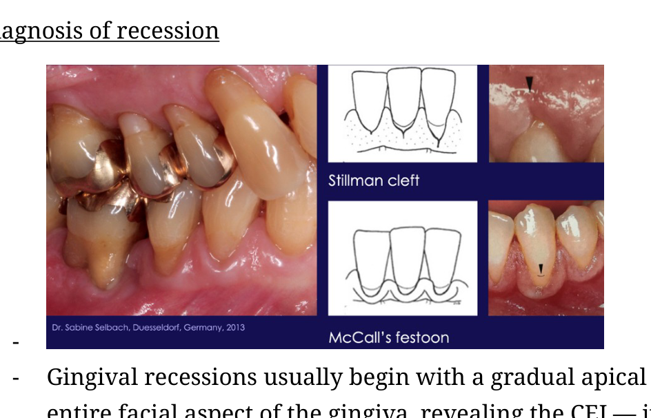 Clinical images illustrating Stillman cleft and McCall's festoon alongside their schematic representations.