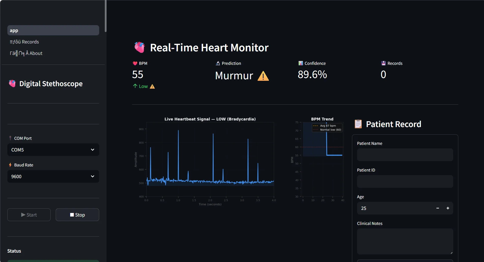 Fig. 5b: Streamlit dashboard showing abnormal heart sound classification with murmur prediction (Panel B).