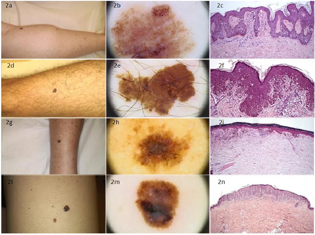 Fig. 1: Clinical background and dermoscopy