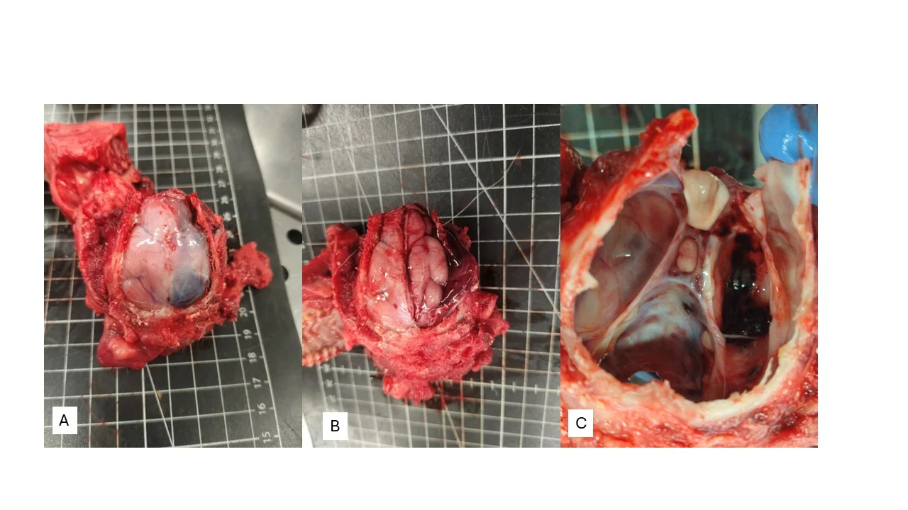 Intracranial and perioptic lesions. (A) Hematoma affecting the right cerebral hemisphere. (B) Subdural hematoma. (C) Hemorrhagic and suppurative material extending toward the optic canal.