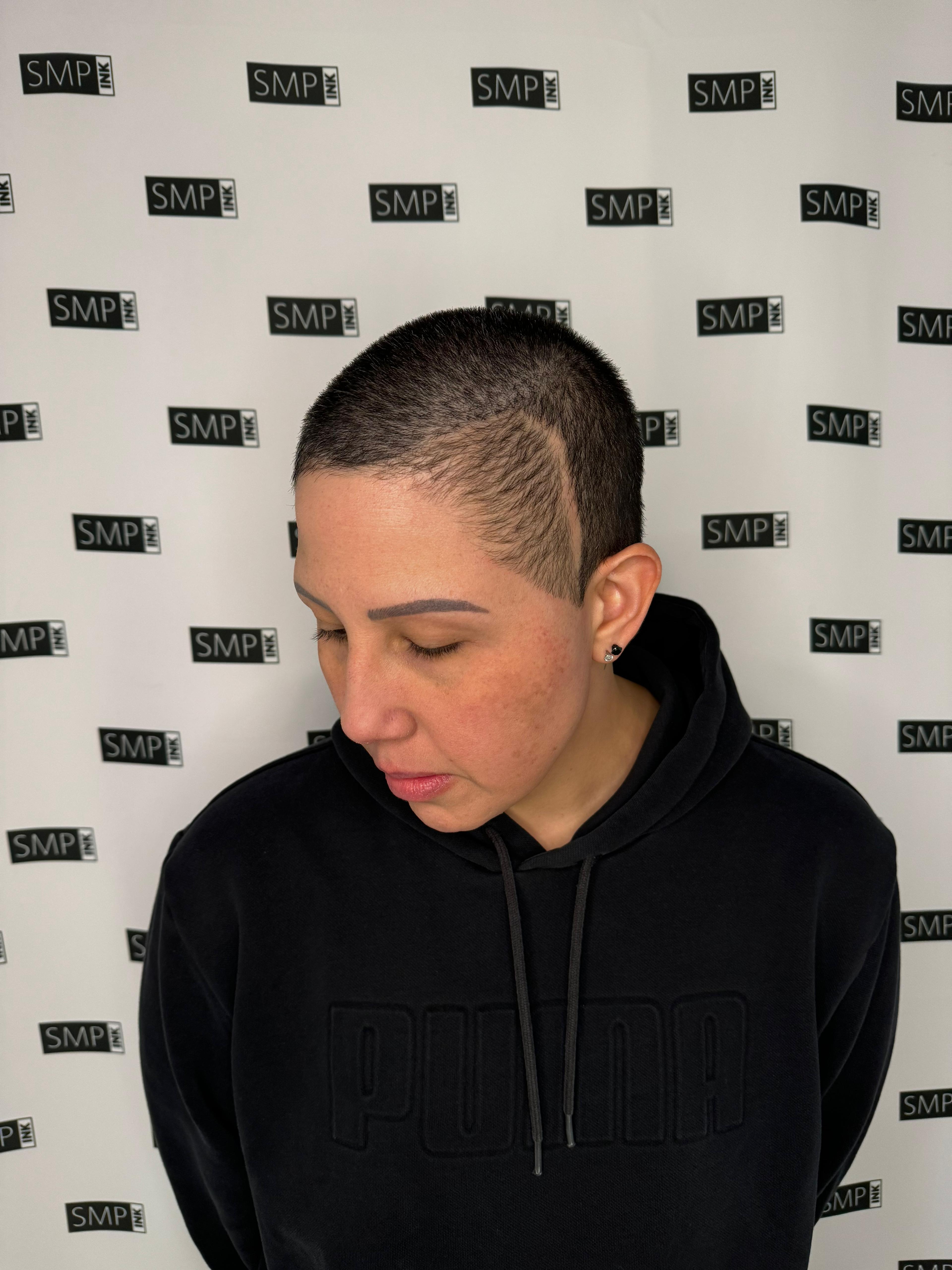 Polished scalp micropigmentation for scar camouflage