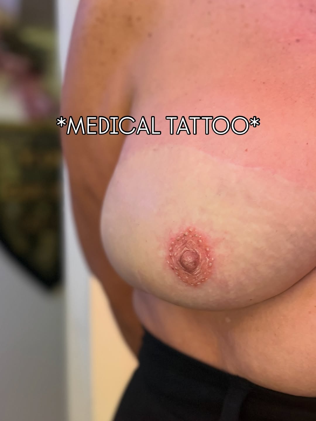 Subtle areola tattoo on reconstructed breast, softly shaded