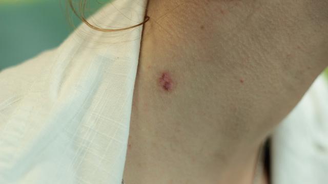 Мазью Стефалин эффективно удалять родинки