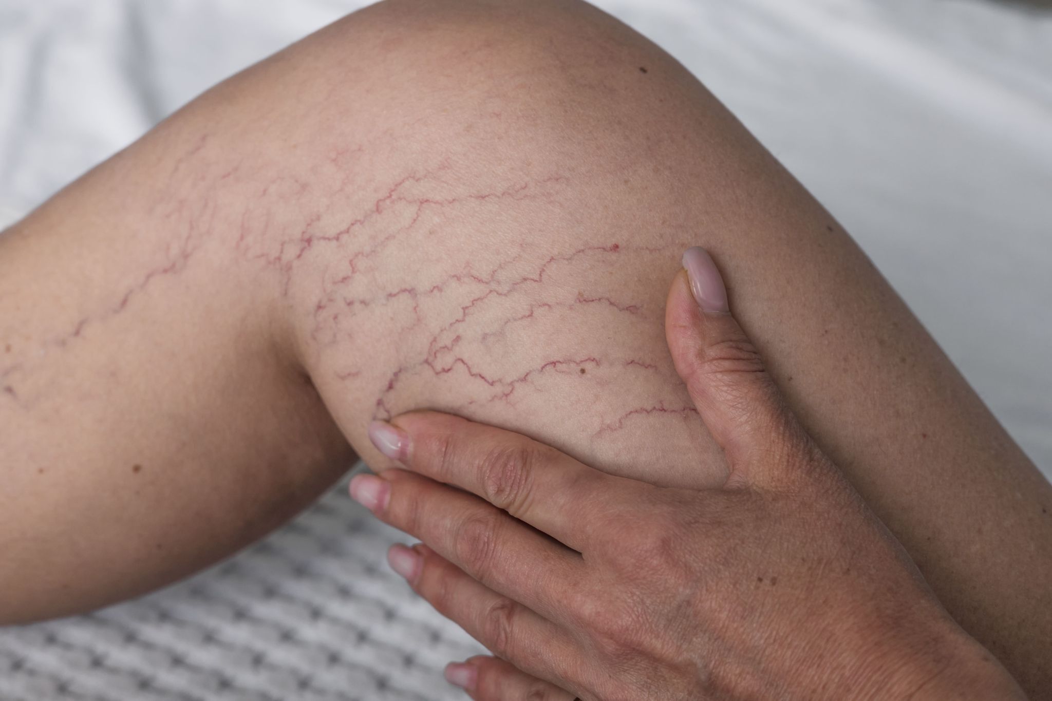 Laser for Spider Veins Cost What Patients Should Expect (3).jpg