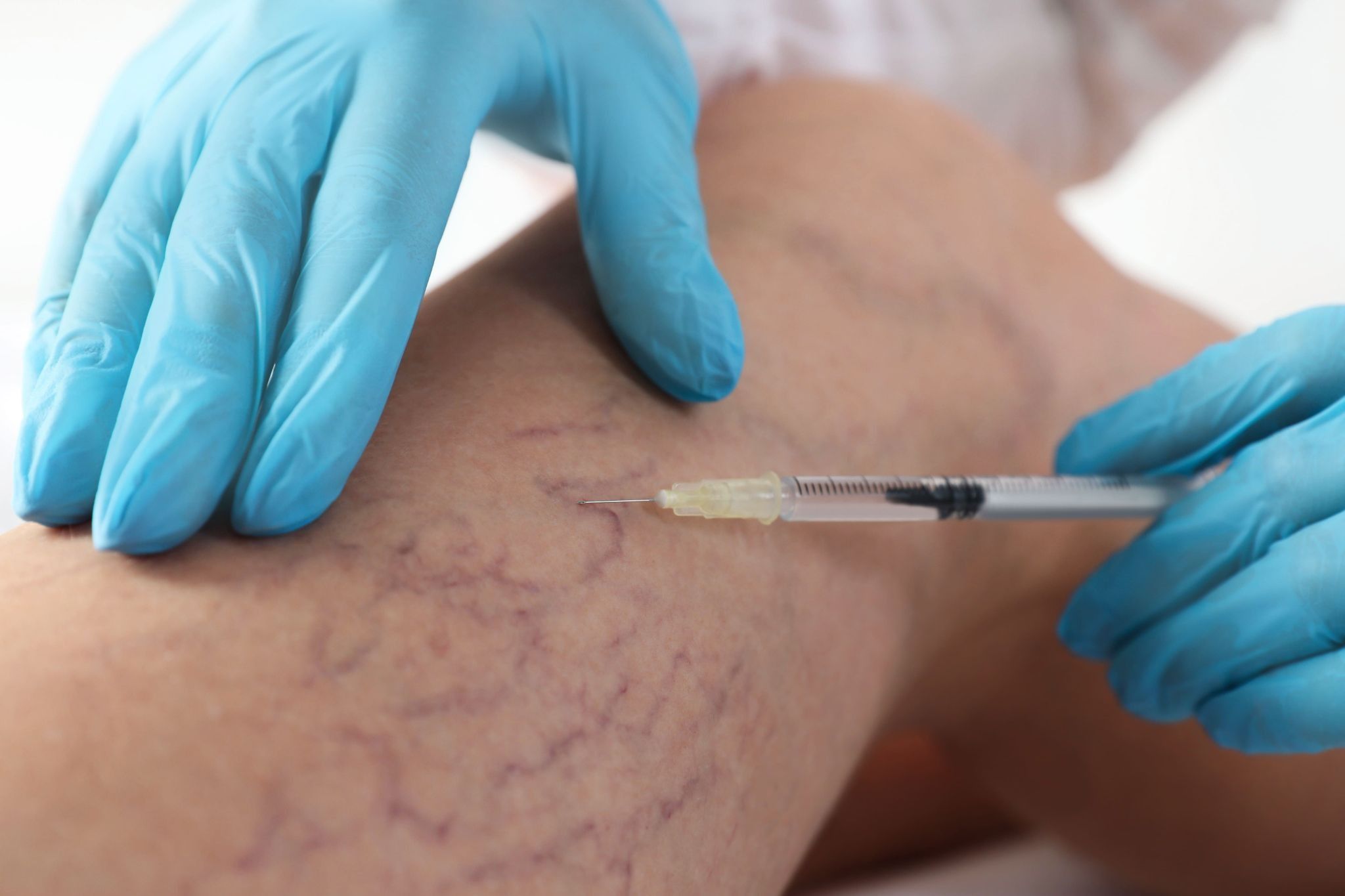 Laser for Spider Veins Cost What Patients Should Expect (4).jpg