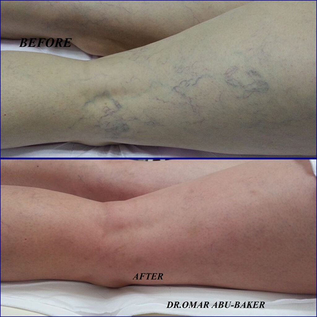 Laser for Spider Veins Cost What Patients Should Expect.jpg